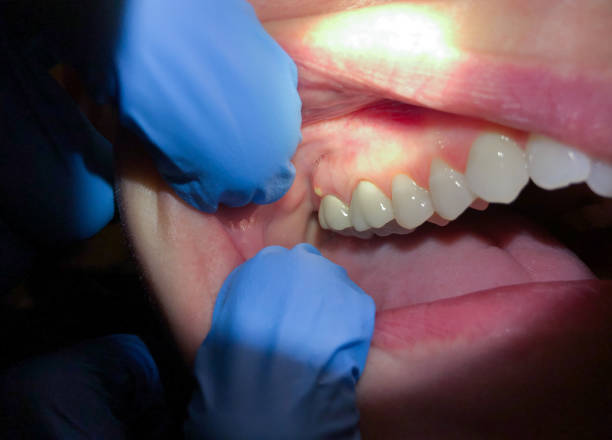 Best Root Canal Emergency Dentist  in Bloomingdale, IL